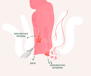 Quem são as famosas hemorroidas? - Dra. Aline Celeghini