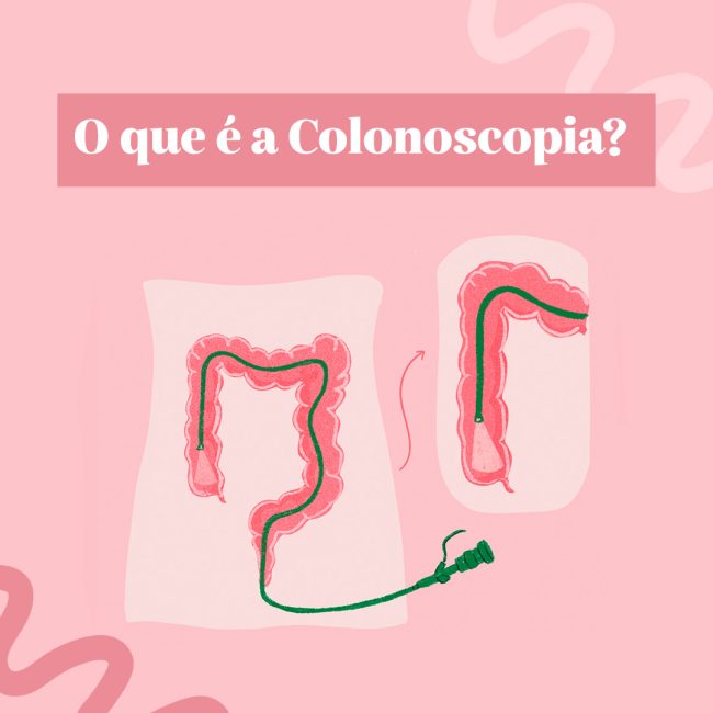 O que é a colonoscopia? - Dra. Aline Celeghini Coloproctologista