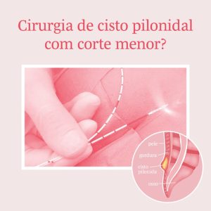 Cisto pilonidal: o que é, sintomas e cirurgia